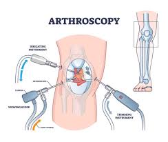 Arthroscopy