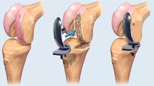Joint Replacement Surgery
