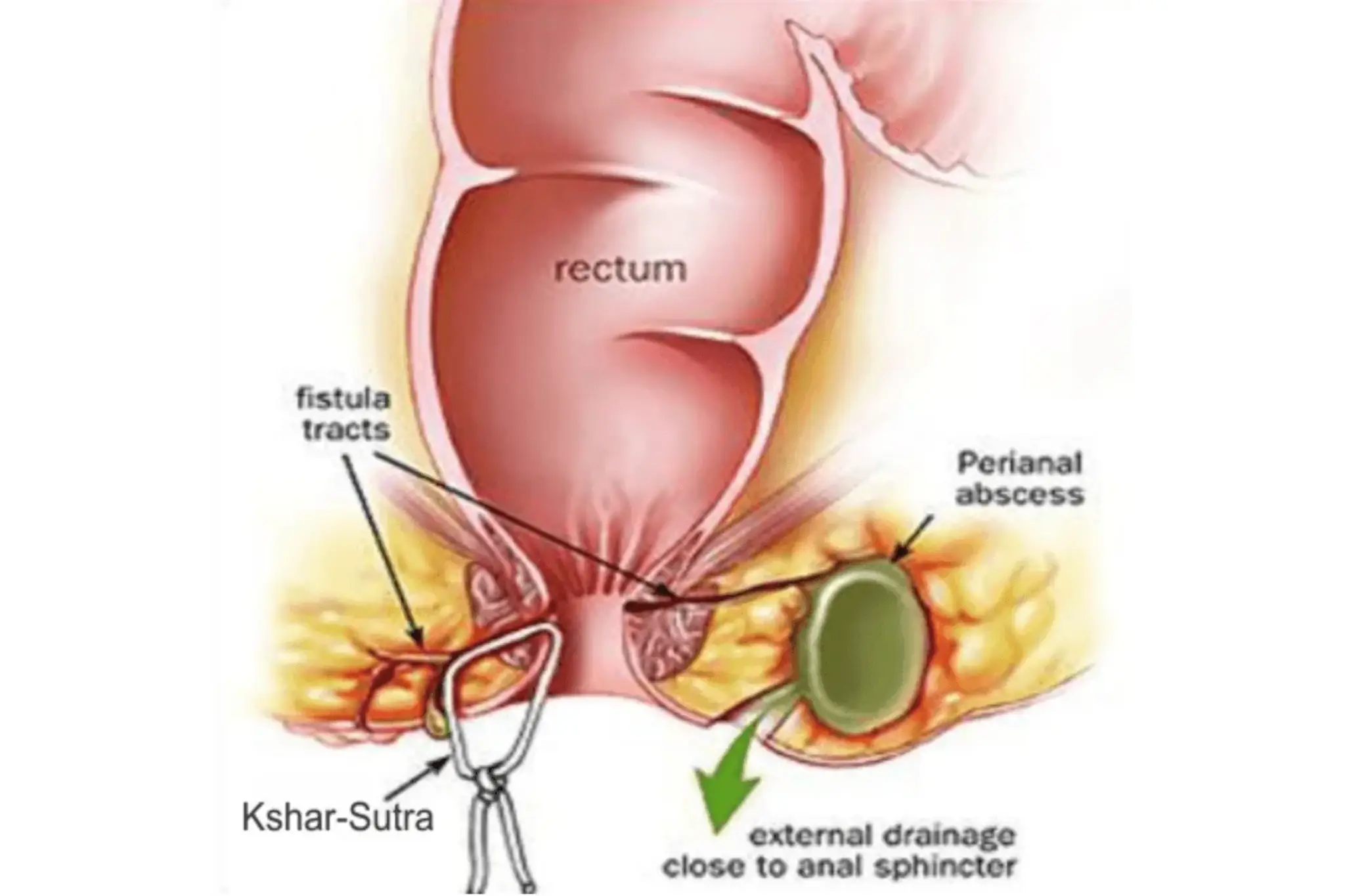 Ksharsutra Treatment in Pune