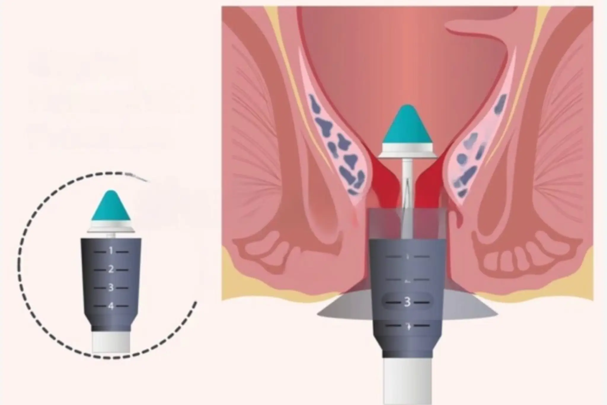 STARR Surgery in Pune